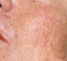 Laserové odstranění žilky na obličeji