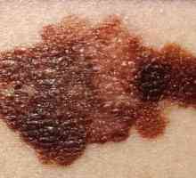 Léčba melanomu: základní techniky