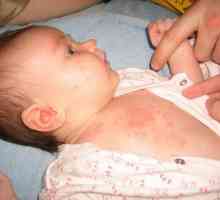 Potnichki léčba u kojenců