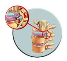Léčení spinální herniace: základní techniky