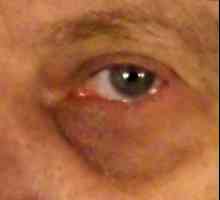 Léčba modřinu pod okem, a populární medicínské metody