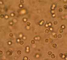 Leukocyty v moči zvýšená: příčiny a důsledky