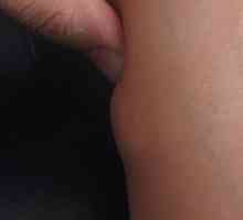 Lipom (mastná tumor) na nohou: příčiny, příznaky a léčba
