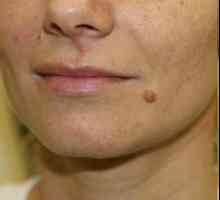 Je možné odstranit skvrny na obličeji bez jizvy? Mohu odstranit mateřské znaménko na tváři, od…