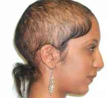 Existuje lék androgenní alopecie? Příčiny vypadávání vlasů. transplantace vlasů