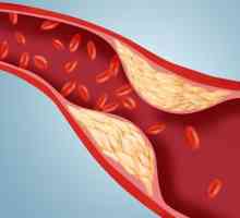 Norma cholesterolu v krvi mužů. Ukazatele hladiny cholesterolu v krvi