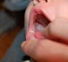 Co se bílé skvrny na jazyku u kojenců