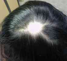Vypadávání vlasů u žen: příčiny, léčba. Prostředky pro plešatost u žen