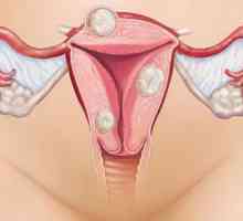 Velmi silné bolesti při menstruaci: příčiny, léčba