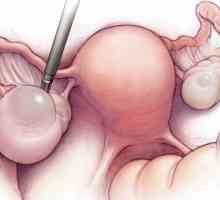 Chirurgické odstranění vaječníků cystu