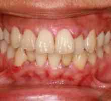 Oteklé dásně, ale zub nebolí - co mám dělat? Způsobuje otoky dásní a léčbě
