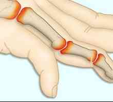 Hlavními příznaky revmatoidní artritidy