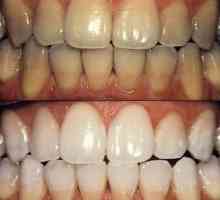 Bělení zubů: typy postupů a vlastností svého chování