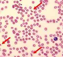 Patologický hemolysis Blood: příčiny, příznaky a léčba
