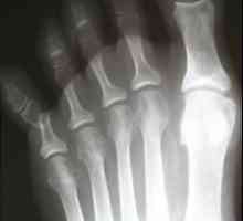 Zlomeniny prstů: příčiny, příznaky a léčba