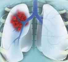Rakovina plic periferní: stadium, léčba, anamnéza. Periferní plicní podíl rakoviny