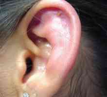 Perichondrium ucha: příznaky, léčba, fotky