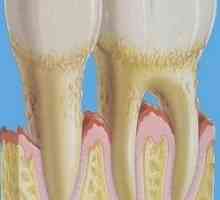 Léčba parodontitidy a příznaky u dospělých