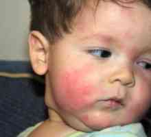 Potravinové alergie u dítěte: co dělat?