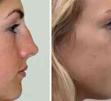 Plastická chirurgie na nose fotografie, recenze