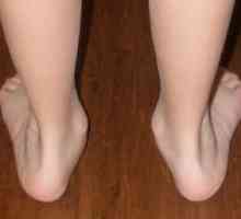 Z nějakého důvodu vytvořit ploché valgózně nohy u dětí a jak s nimi zacházet?