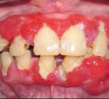 Proč dásně odchyluje od zubu a jak jej vrátit do místa