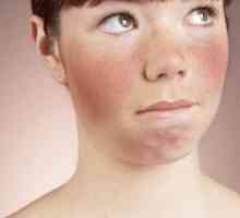 Proč červené tváře: příčiny a léčba