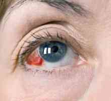 Proč prasknout krevní cévy v očích: příčiny a léčba