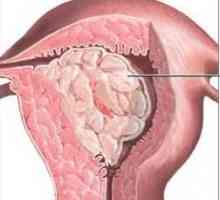 Endometriální polyp, co to je? Příčiny, příznaky a léčebné metody