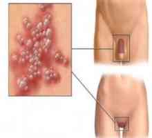 Infekce pohlavních orgánů: prevence, příznaky a léčba