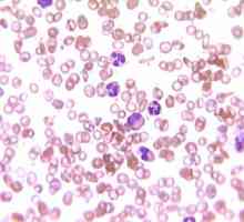 Zvýšený počet bílých krvinek v krvi: to, co je příčinou a co je léčba?