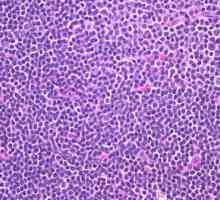 Zvýšený krevní lymfocyty u dětí - je to nebezpečné?