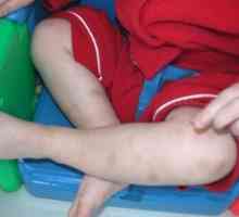 Zvýšená krevní destičky u dítěte: co by mohlo být příčinou?