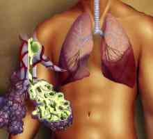 Pravostranné zápal plic: příčiny, příznaky a léčba