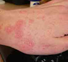 Příčiny alergie na slunce a její metody léčby