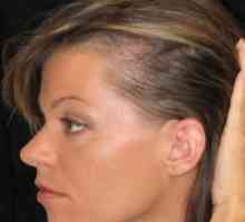 Důvody, které vyvolané difúzní vypadávání vlasů, a jak je řešit