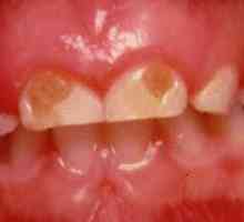 Prevence a léčba zubního kazu u dětí