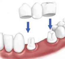 Protéza, při absenci velkého počtu zubů: Druhy