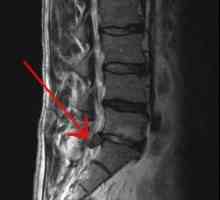Disk výstupek bederní páteře. Jak léčit spinální disk výčnělek?