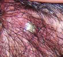 Akné na hlavě pod vlasů: příčiny a funkce léčebné