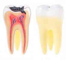 Zubní dřeň - co to je? Pulpitis u dětí primárních zubů: příčiny, příznaky a léčba