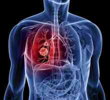 Spinocelulární karcinom plic: popis, příčiny, diagnostika a léčba rysy