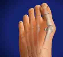 Rostoucí kost v noze: příčiny, příznaky, léčba
