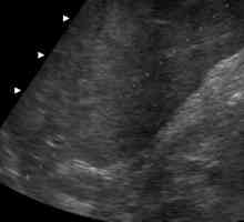 Rozměry normální jaterní ultrazvuku (přepis)