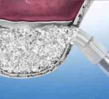 Sinus lift: použití v zubní implantáty. Typy, indikace, možné komplikace