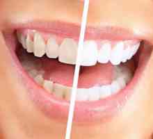 Teeth Whitening System Global White: recenze. Globální Bílá: klady a zápory