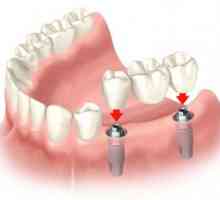 Kolik je implantace jednoho zubu v moderních nemocnicích