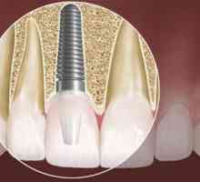 Kolik je vložit zuby? Dentální implantáty - alternativní způsob, jak se vrátit do své bývalé krásy…