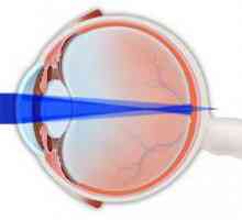 Sloučenina myopický astigmatismus do obou očí u dětí: Léčba