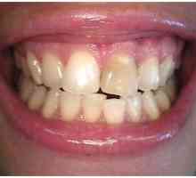Moderní stomatologie: jeden bělení zubů